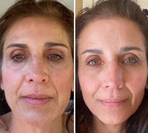 FaceGlow Pro™ Recupera la firmeza y la confianza en solo minutos al día desde Casa