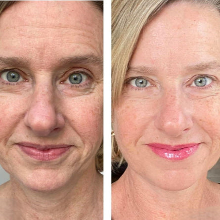 FaceGlow Pro™ Recupera la firmeza y la confianza en solo minutos al día desde Casa