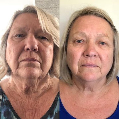FaceGlow Pro™ Recupera la firmeza y la confianza en solo minutos al día desde Casa