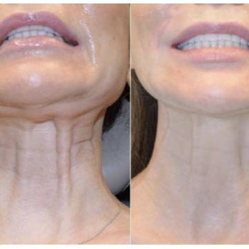 FaceGlow Pro™ Recupera la firmeza y la confianza en solo minutos al día desde Casa